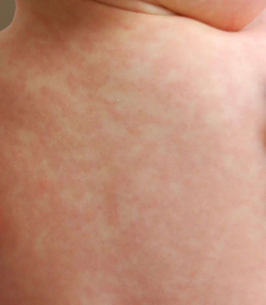 What Are the Causes of a Rash on the Chest? | LIVESTRONG.COM