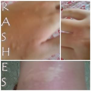 rash